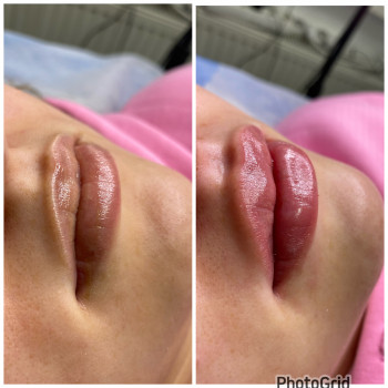 Контурна пластика губ.До та після.