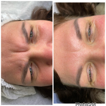 Результат роботи ботулотоксином!