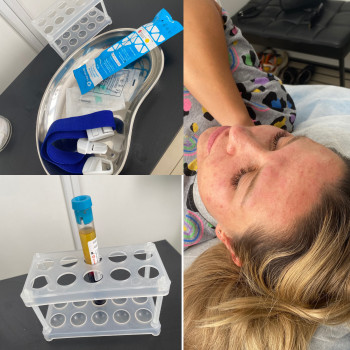 Плазмотерапія обличчя.