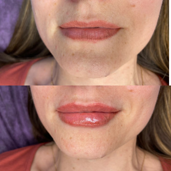 Збільшення губ одразу після процедури!І татуажу років два!