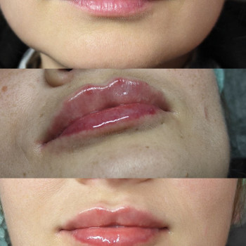 Корекція губ без надмірного ефекту. Аугментація губ. Контурна пластика губ. Плоский бант.