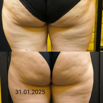 Результати антицелюлітного