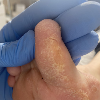 Тріщини
Подологічна обробка
ДО/