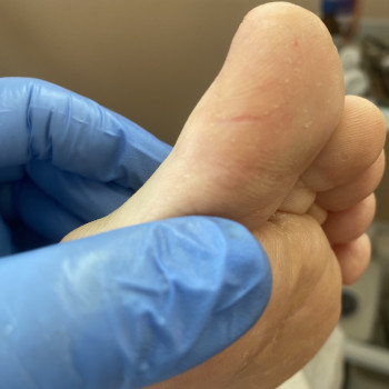 Тріщини
Подологічна обробка
ПІСЛЯ/