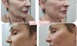 7 точок ліфтингу Косметолог  Київ