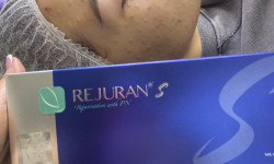 Біоревіталізація Мастер перманентного макияжа Ольга Новикова Харьков