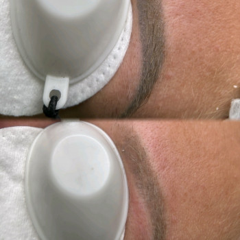 Видалення перманенту лазером