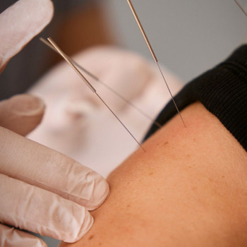 Голковколювання в тригерні точки