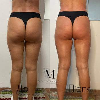 Корекція фігури за допомогою комбінованого масажу
                    Фізіотерапевт Марина Суми