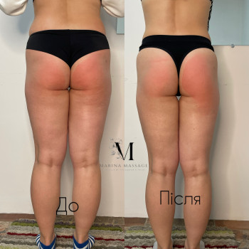 Корекція фігури за допомогою комбінованого масажу
                    Фізіотерапевт Марина Суми