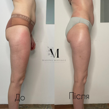 Корекція фігури за допомогою комбінованого масажу
                    Фізіотерапевт Марина Суми