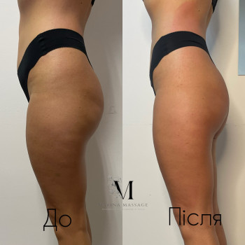 Корекція фігури за допомогою комбінованого масажу
                    Фізіотерапевт Марина Суми