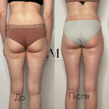 Корекція фігури за допомогою комбінованого масажу
                    Фізіотерапевт Марина Суми