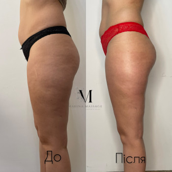 Корекція фігури за допомогою комбінованого масажу
                    Фізіотерапевт Марина Суми