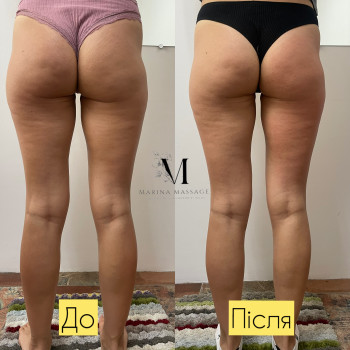 Корекція фігури за допомогою комбінованого масажу
                    Фізіотерапевт Марина Суми