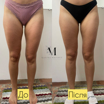 Корекція фігури за допомогою комбінованого масажу
                    Фізіотерапевт Марина Суми