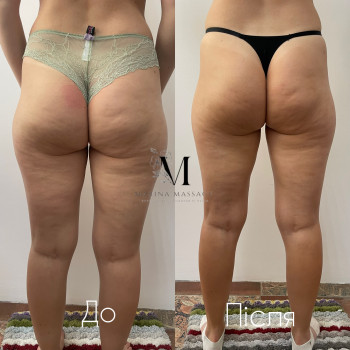 Корекція фігури за допомогою комбінованого масажу
                    Фізіотерапевт Марина Суми