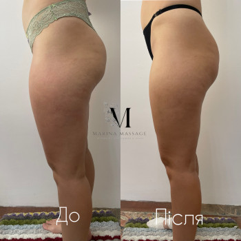 Корекція фігури за допомогою комбінованого масажу
                    Фізіотерапевт Марина Суми