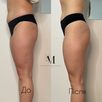 Корекція фігури за допомогою комбінованого масажу
                    Фізіотерапевт Марина Суми