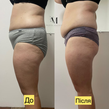Корекція фігури за допомогою комбінованого масажу
                    Фізіотерапевт Марина Суми