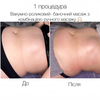 Корекція фігури за допомогою комбінованого масажу
                    Фізіотерапевт Марина Суми