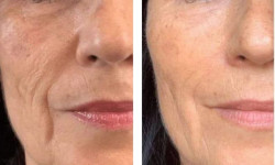 Аппаратный FullFace (расширенный протокол) — MAX ПАКЕТ Салон краси Мастерская Красоты "Юлии Юдиной" Київ