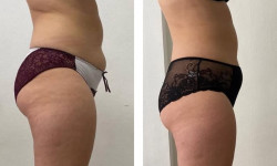 Программа локального похудения Slim Body та Slim Body + Endo Салон красоты Мастерская Красоты "Юлии Юдиной" Киев