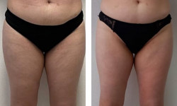 Программа пассивного и локального похудения Slim Body Салон красоты Мастерская Красоты "Юлии Юдиной" Киев