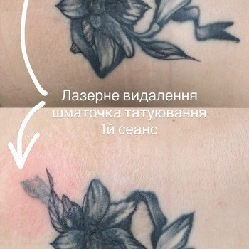 Видалення тату лазером
 