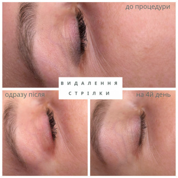 Удаление перманента и тату
                    Лешмейкер Світлана Киев