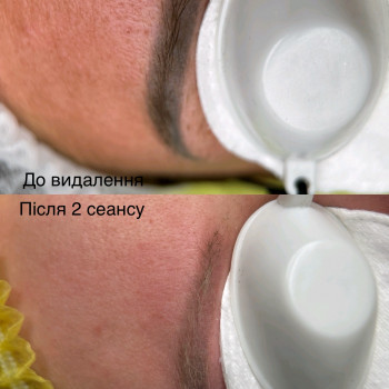 Лазерне аидалення татуажу брів