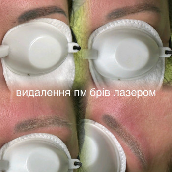 Удаление перманента и тату
                    Лешмейкер Світлана Киев