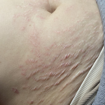 Мікронідлінг
                    Електролог Юлія Знам'янка