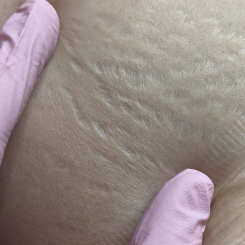 Мікронідлінг
                    Електролог Юлія Знам'янка