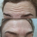 BOTOX  (три зони - знижка) Лікар-косметолог Олеся Тернопіль