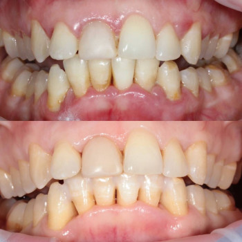 професійна гігієна