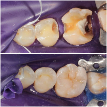 Лікування карієсу