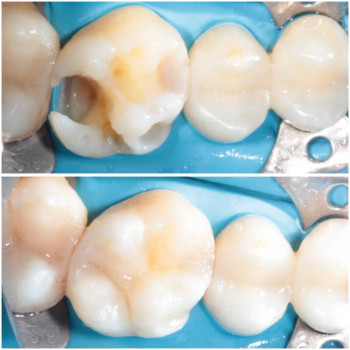 Лікування карієсу