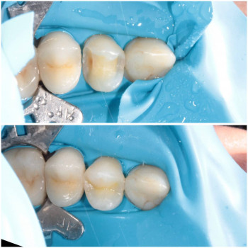 Лікування карієсу