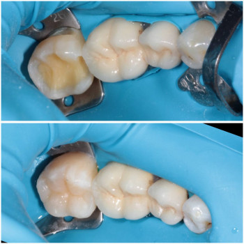 Лікування карієсу