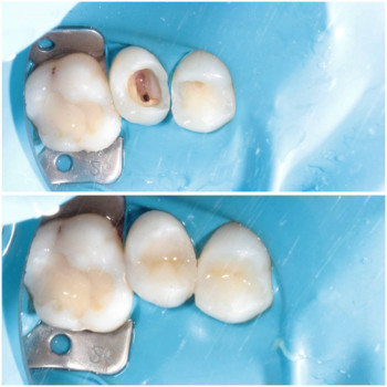 Лікування карієсу