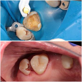 Лікування карієсу