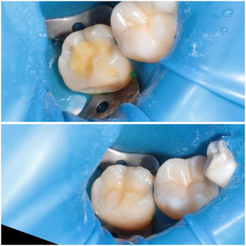 Лікування карієсу