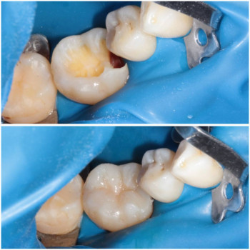 Лікування карієсу
