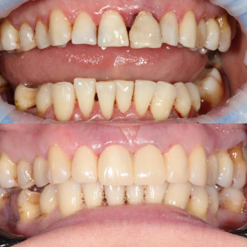 лікування пародонтиту