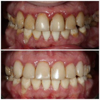 лікування пародонтиту