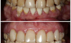 Комплексное лечение заболеваний десен Стоматологическая клиника VA Clinic Хмельницкий