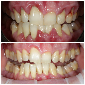 лікування пародонтиту