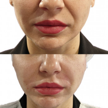 Колагеностимуляція гідроксиапатитом кальцієм., фото - лікар-косметолог Олександр Шадських