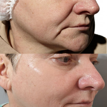 Колагеностимуляція гідроксиапатитом кальцієм., фото - лікар-косметолог Олександр Шадських